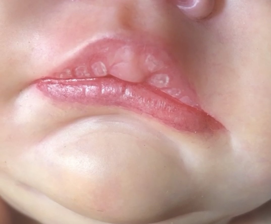 Blister Lip Medium